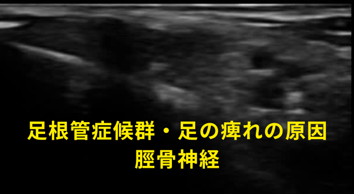 刈谷・安城・知立・東浦・大府で評判の刈谷はりきゅうマッサージ院はエコーを用いて、足根管症候群・足の痺れの原因となる神経や筋膜に対して鍼灸・神経施術を行う