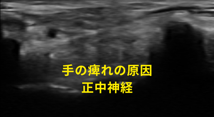 刈谷・安城・知立・東浦・大府で評判の刈谷はりきゅうマッサージ院はエコーを用いて、手の痺れ・手根管症候群の原因となる神経や筋膜に対して鍼灸・神経施術を行う
