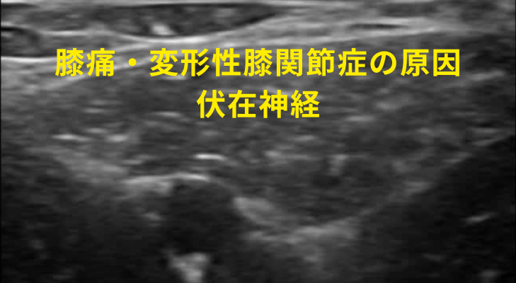 刈谷・安城・知立・東浦・大府で評判の刈谷はりきゅうマッサージ院はエコーを用いて、膝痛・変形性膝関節症の原因となる神経や筋膜に対して鍼灸・神経施術を行う