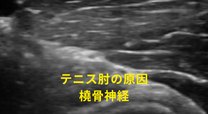 刈谷・安城・知立・東浦・大府で評判の刈谷はりきゅうマッサージ院はエコーを用いて、スポーツ障害（シンスプ・オスグッド・テニス肘）の原因となる神経や筋膜に対して鍼灸・神経施術を行う