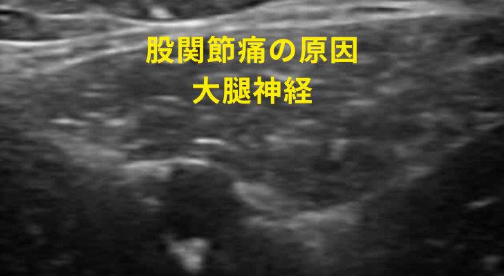 刈谷・安城・知立・東浦・大府で評判の刈谷はりきゅうマッサージ院はエコーを用いて、股関節痛の原因となる神経や筋膜に対して鍼灸・神経施術を行う