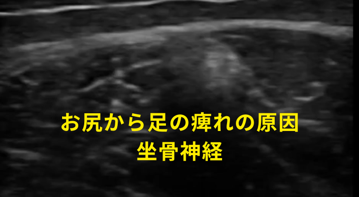 刈谷・安城・知立・東浦・大府で評判の刈谷はりきゅうマッサージ院はエコーを用いて、坐骨神経痛の原因となる神経や筋膜に対して鍼灸・神経施術を行う