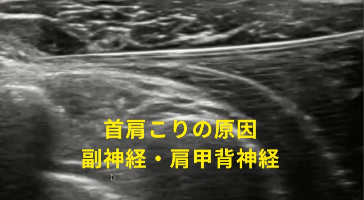 刈谷・安城・知立・東浦・大府で評判の刈谷はりきゅうマッサージ院はエコーを用いて、首肩こりの原因となる神経や筋膜に対して鍼灸・神経施術を行う
