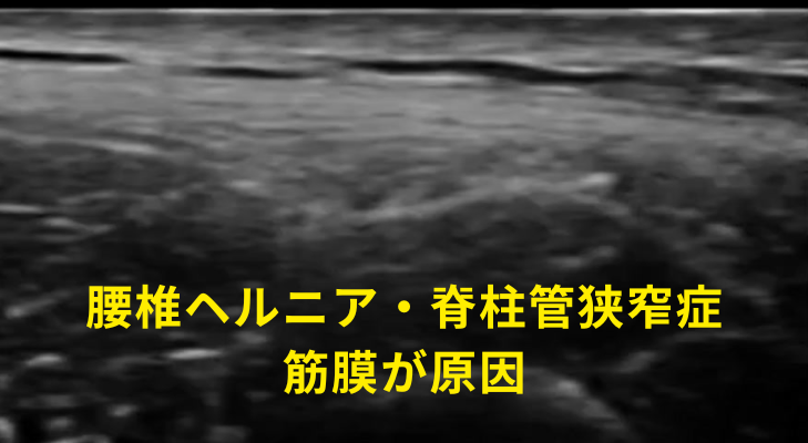 刈谷・安城・知立・東浦・大府で評判の刈谷はりきゅうマッサージ院はエコーを用いて、脊柱管狭窄症・腰椎ヘルニアの原因となる神経や筋膜に対して鍼灸・神経施術を行う